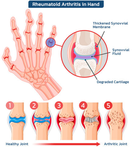🐝Seurico™ New Zealand Bee Venom Joint Relief Gel(New Zealand Bee Extract - Specializes in the treatment of orthopedic conditions and arthritic pain)