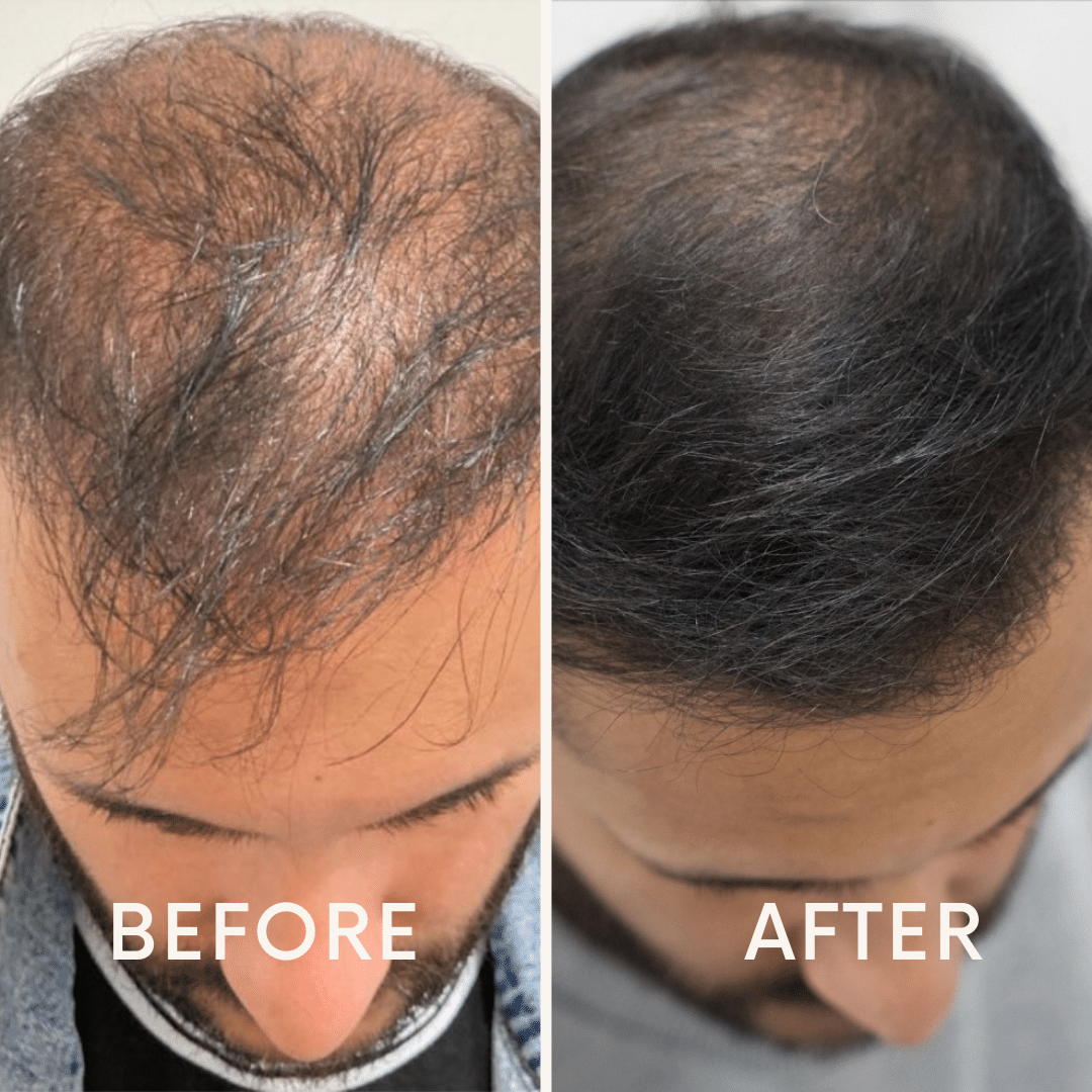 Seurico™ | Laser Cap for Hair Growth ❤️