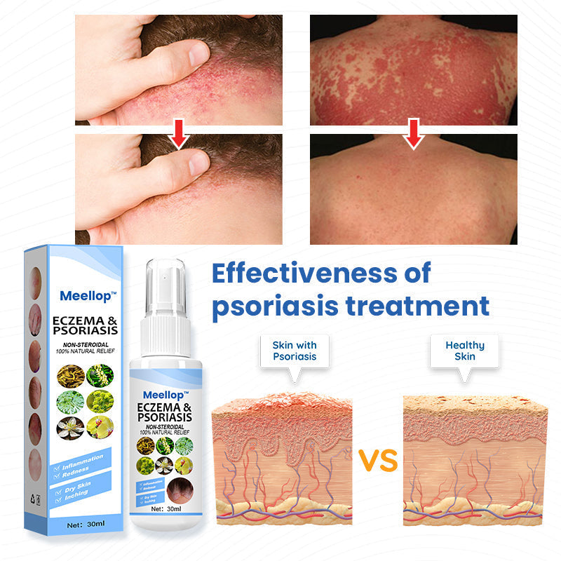 Meellop™ Herbal Psoriasis Relief Spray