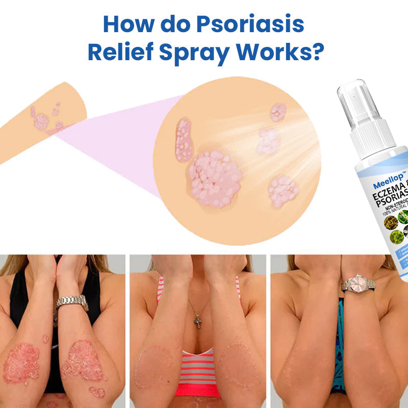 Meellop™ Herbal Psoriasis Relief Spray