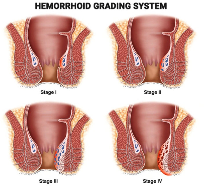 Pure Natural Herbal Hemorrhoid Ointment