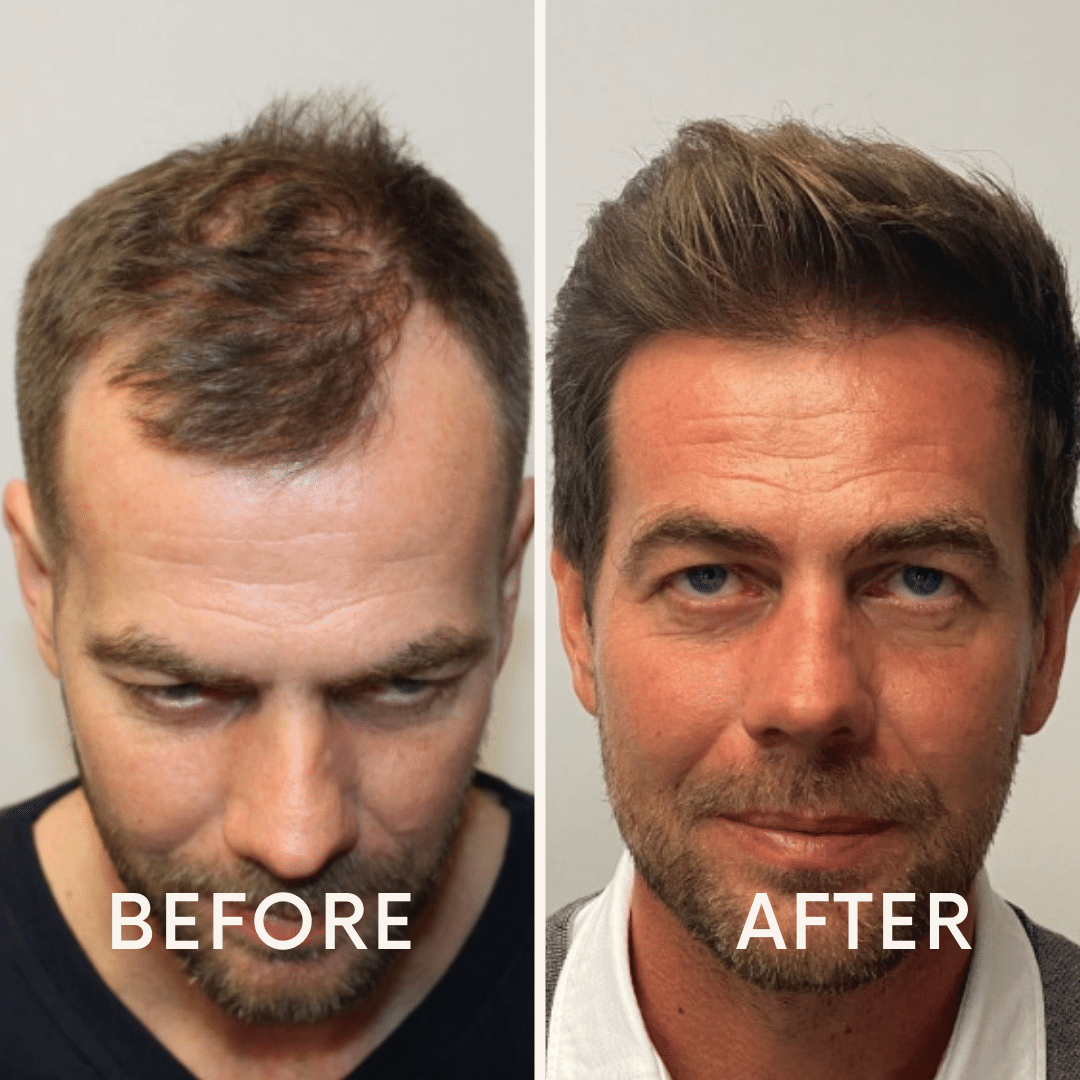 Seurico™ |  Laser Cap for Hair Growth ❤️