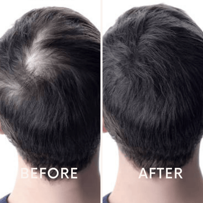 Seurico™ |  Laser Cap for Hair Growth ❤️