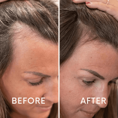 Seurico™ |  Laser Cap for Hair Growth ❤️