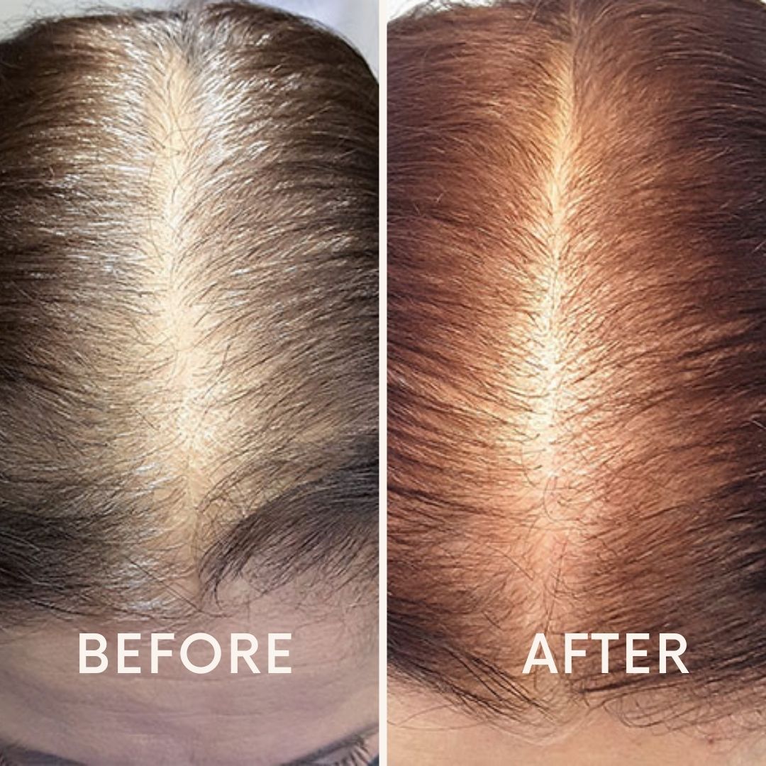 Seurico™ |  Laser Cap for Hair Growth ❤️