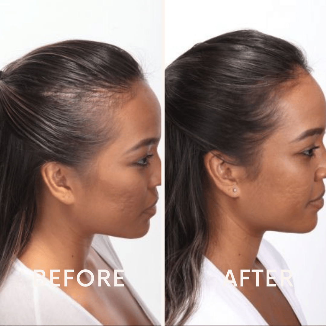 Seurico™ |  Laser Cap for Hair Growth ❤️