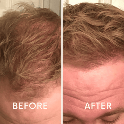Seurico™ |  Laser Cap for Hair Growth ❤️