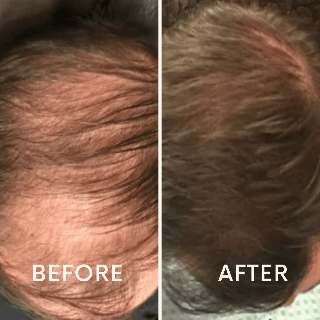 Seurico™ |  Laser Cap for Hair Growth ❤️