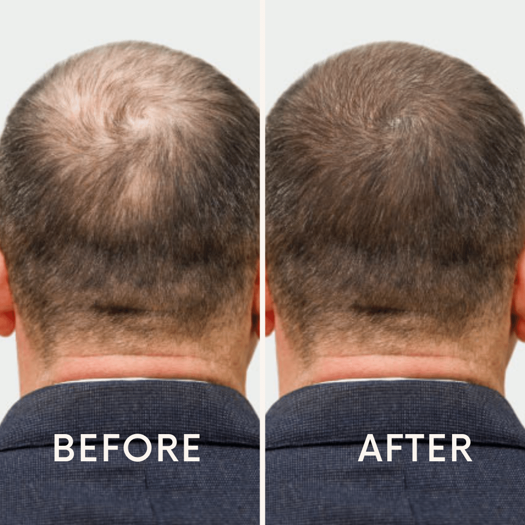 Seurico™ |  Laser Cap for Hair Growth ❤️