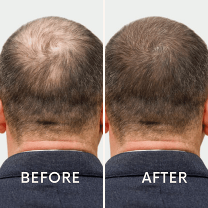 Seurico™ |  Laser Cap for Hair Growth ❤️